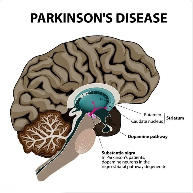 Parkinson's Disease Treatment in Rohini