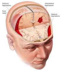 Traumatic Brain Injury Treatment in Rohini