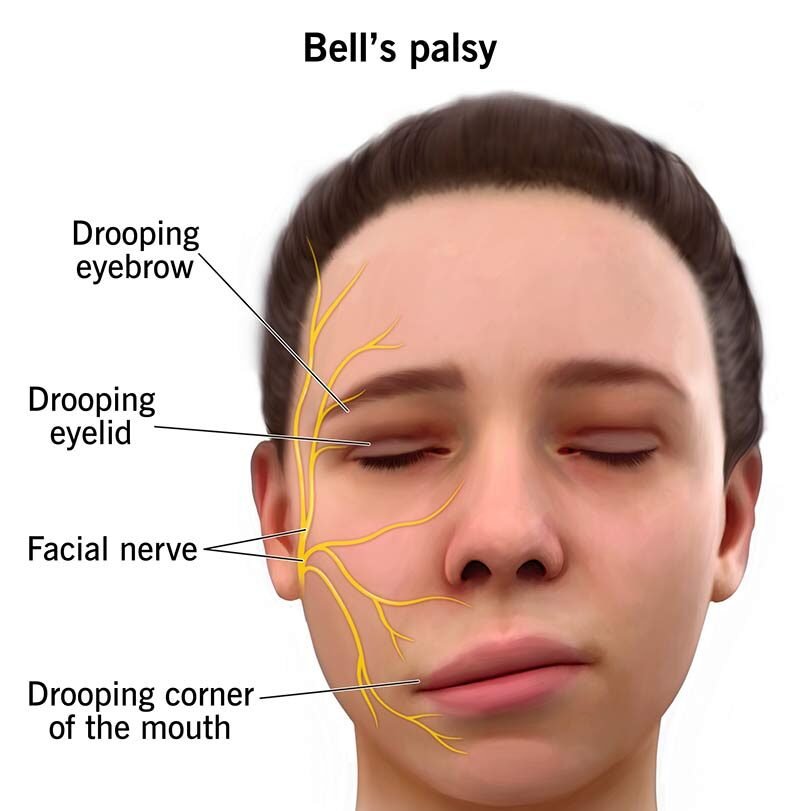 Bell's Palsy Treatment in Rohini