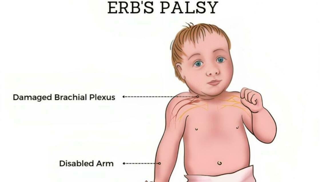 Erb's Palsy Treatment in Rohini