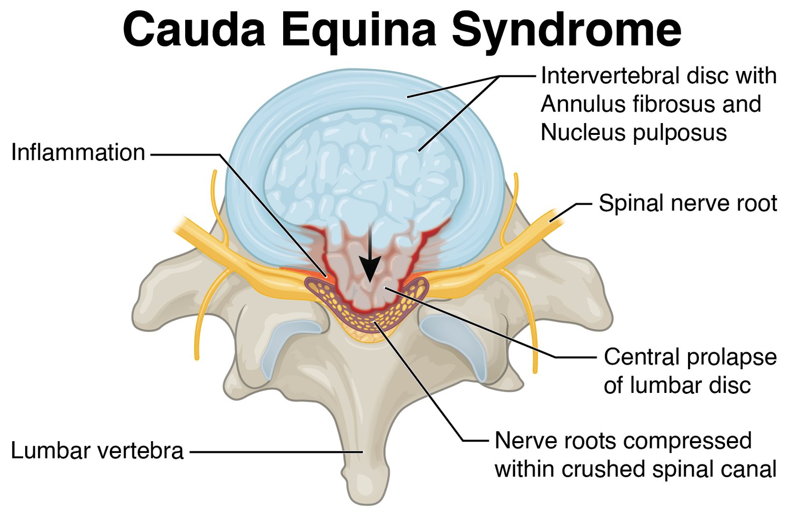 Cauda Equina Syndrome Treatment Doctors in New Delhi